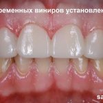 Temporary veneers on the upper jaw