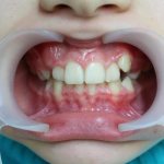 Высокое низкое положение отдельных зубов исправление