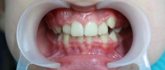 High low position of individual teeth correction