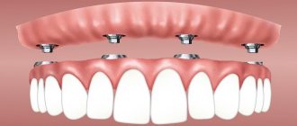 implantation of dental implants