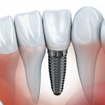 Замена утраченного зуба - Стоматология «Линия Улыбки»