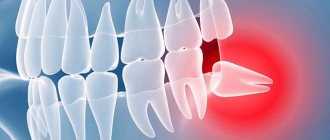 wisdom tooth growing incorrectly