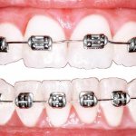 teeth braces