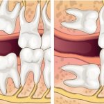 Зубы мудрости у детей